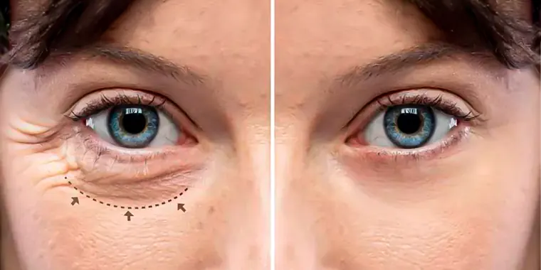 Blefaroplastia